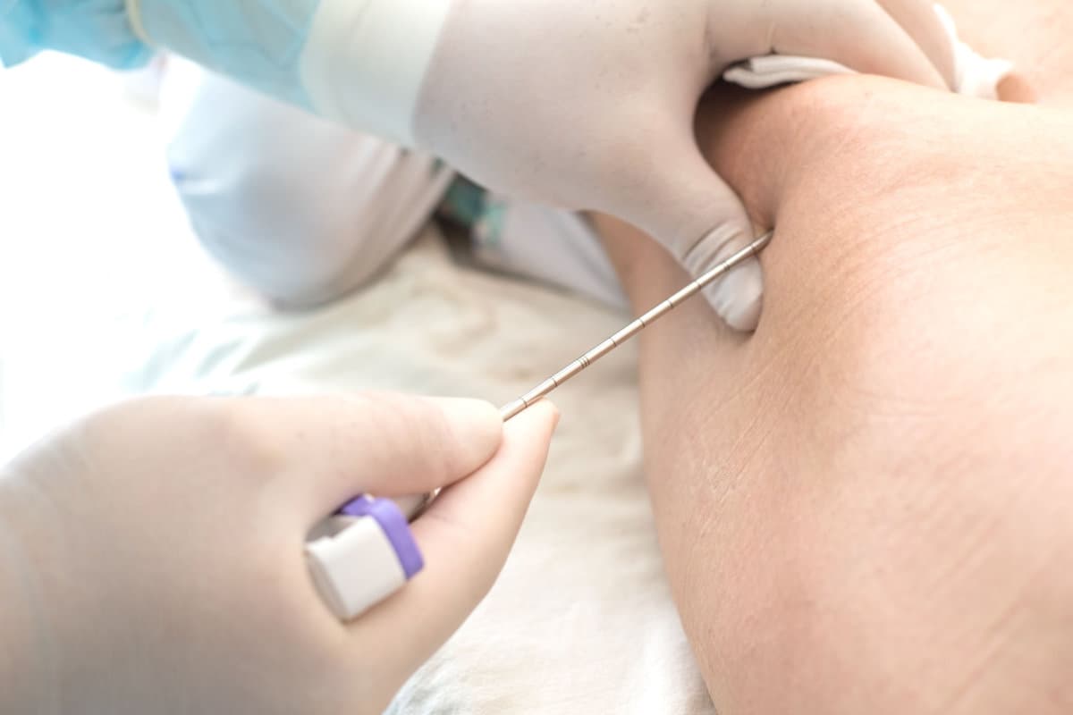 An oncologist, using a long needle, pierces a childs ilium to diagnose bone marrow for leukemia, Ewings sarcoma