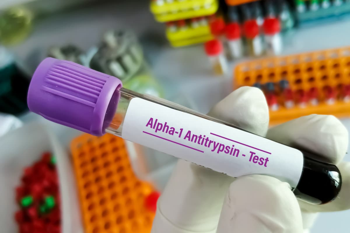 Scientist hold blood sample tube for Alpha 1 antitrypsin (A1AT) Test. alpha-1 antitrypsin deficiency, COPD