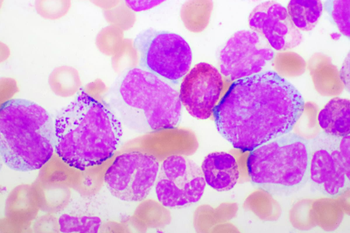 Chronic myeloid leukemia cells or CML, analyze by microscope