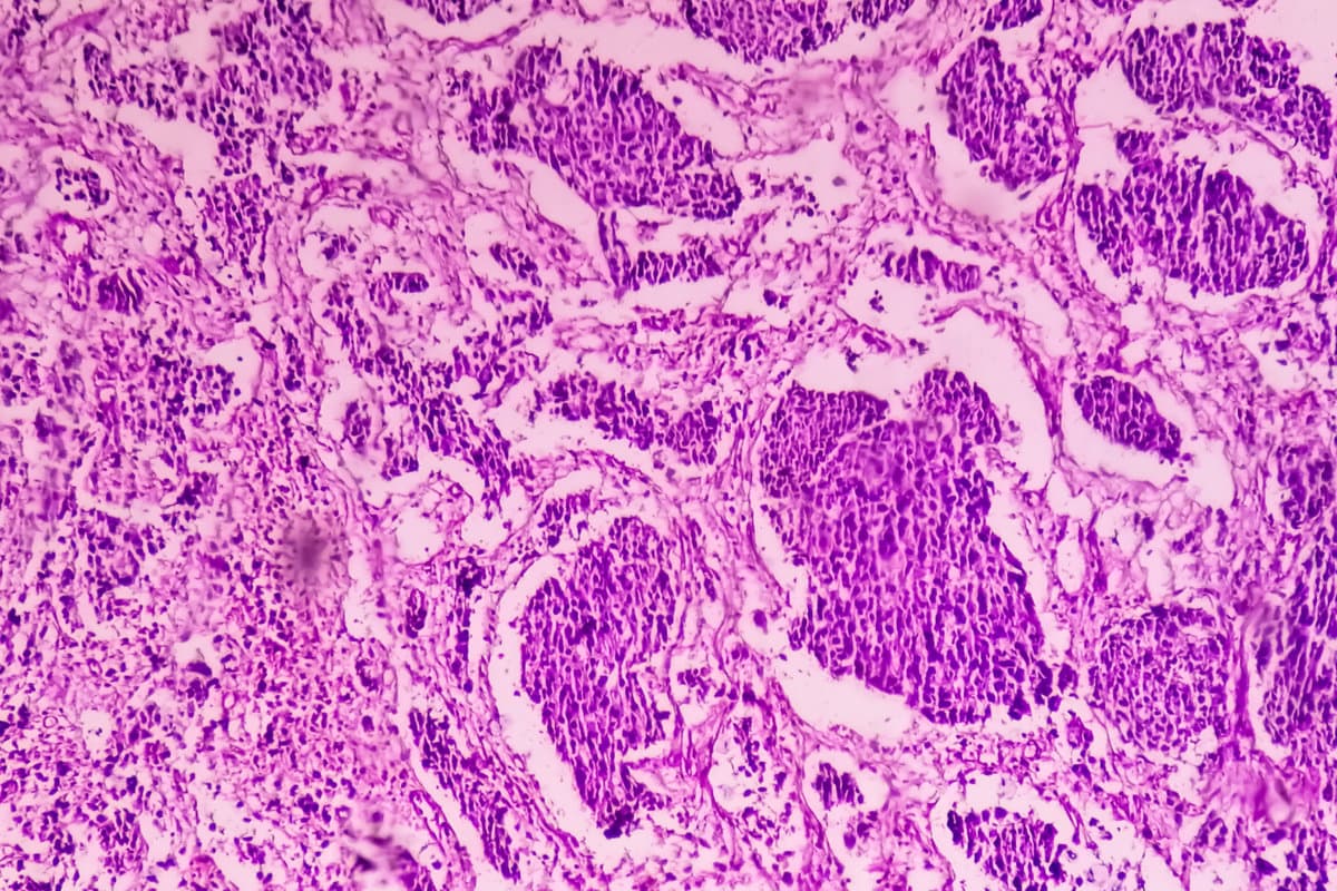 Bladder Cancer: High grade transitional cell carcinoma (TCC), Urothelial carcinoma