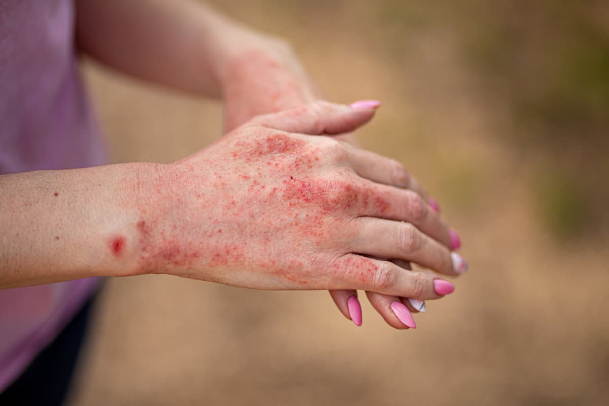 Nahaufnahme von Dermatitis auf der Haut, krankem allergischem Hautausschlag, Ekzemhaut des Patienten, atopischer