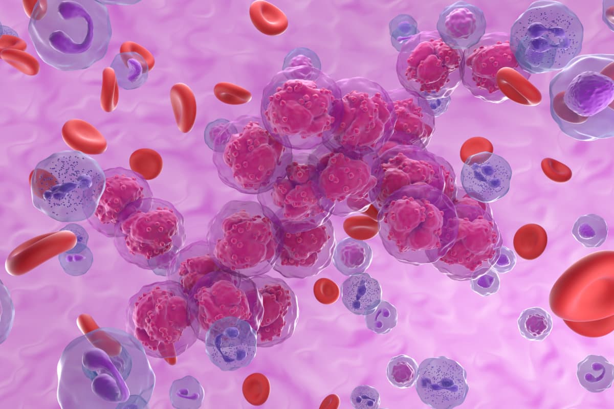 Acute lymphoblastic leukemia (ALL) cancer cell clusters in the b