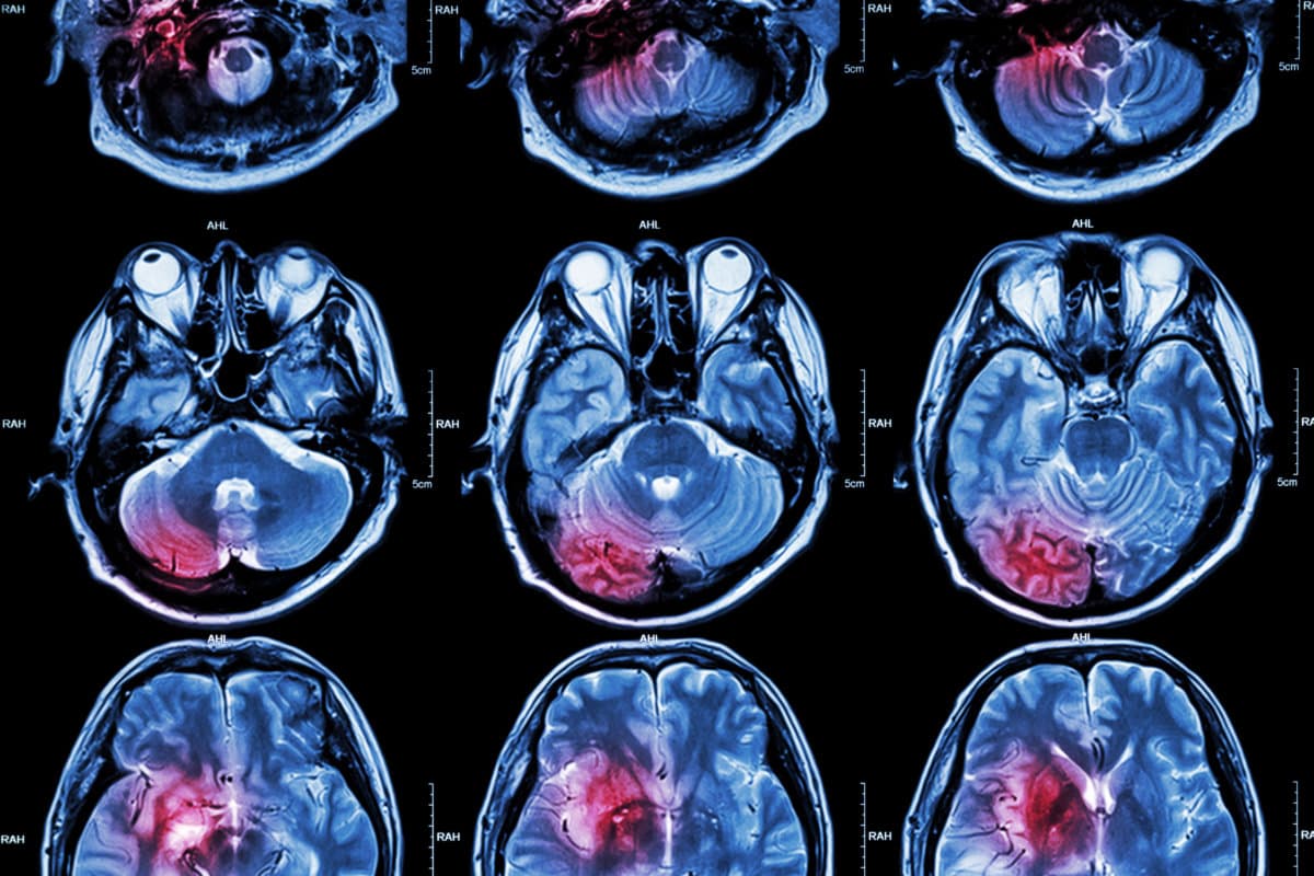 Film-MRT (Magnetresonanztomographie) des Gehirns (Schlaganfall, Gehirntumor, Hirninfarkt, intrazerebrale Blutung) (Medizin,