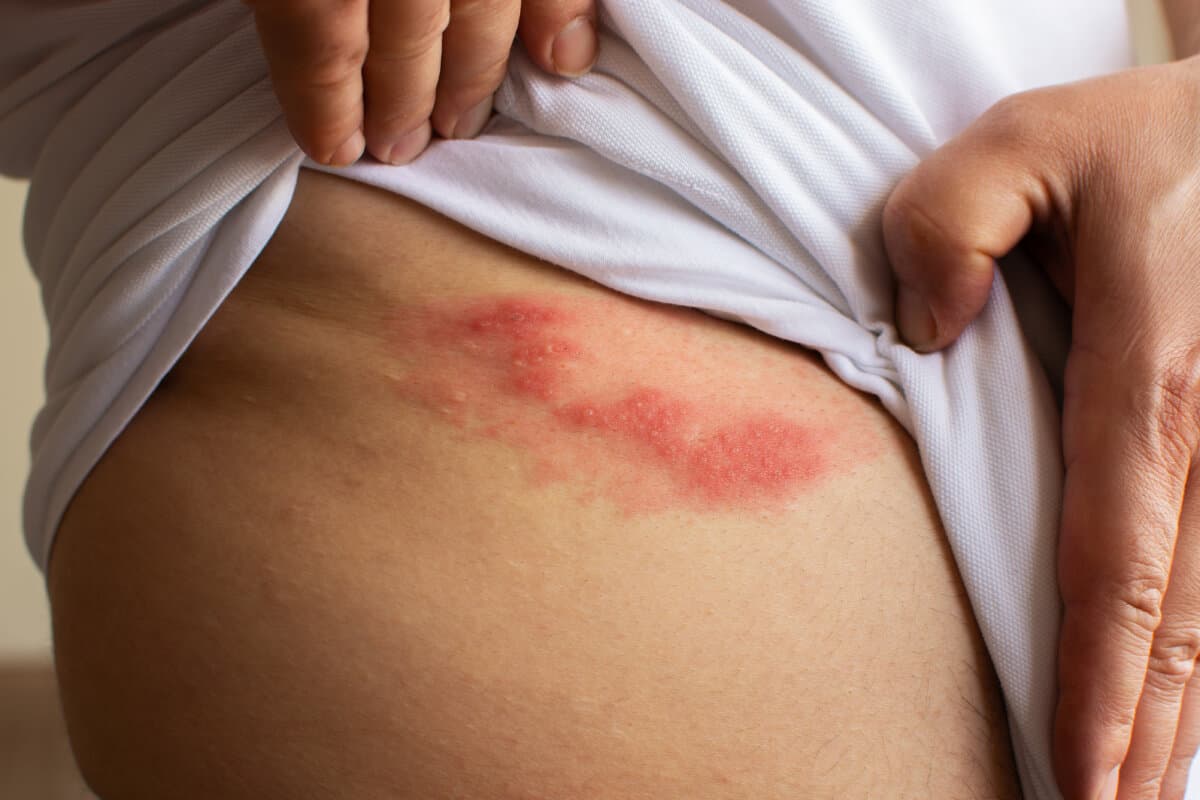 Shingles (herpes zoster) blister skin rash