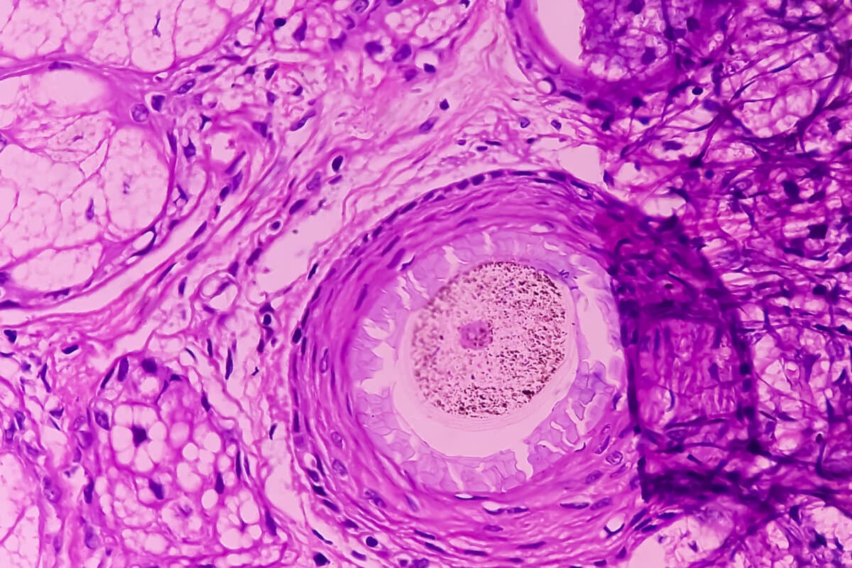 Mature cystic teratoma, Ovarian cyst biopsy, show cyst wall of skin and adnexal structure, fatty tissue, salivary acini and cartilage. Cystic teratoma of dermoid cyst.