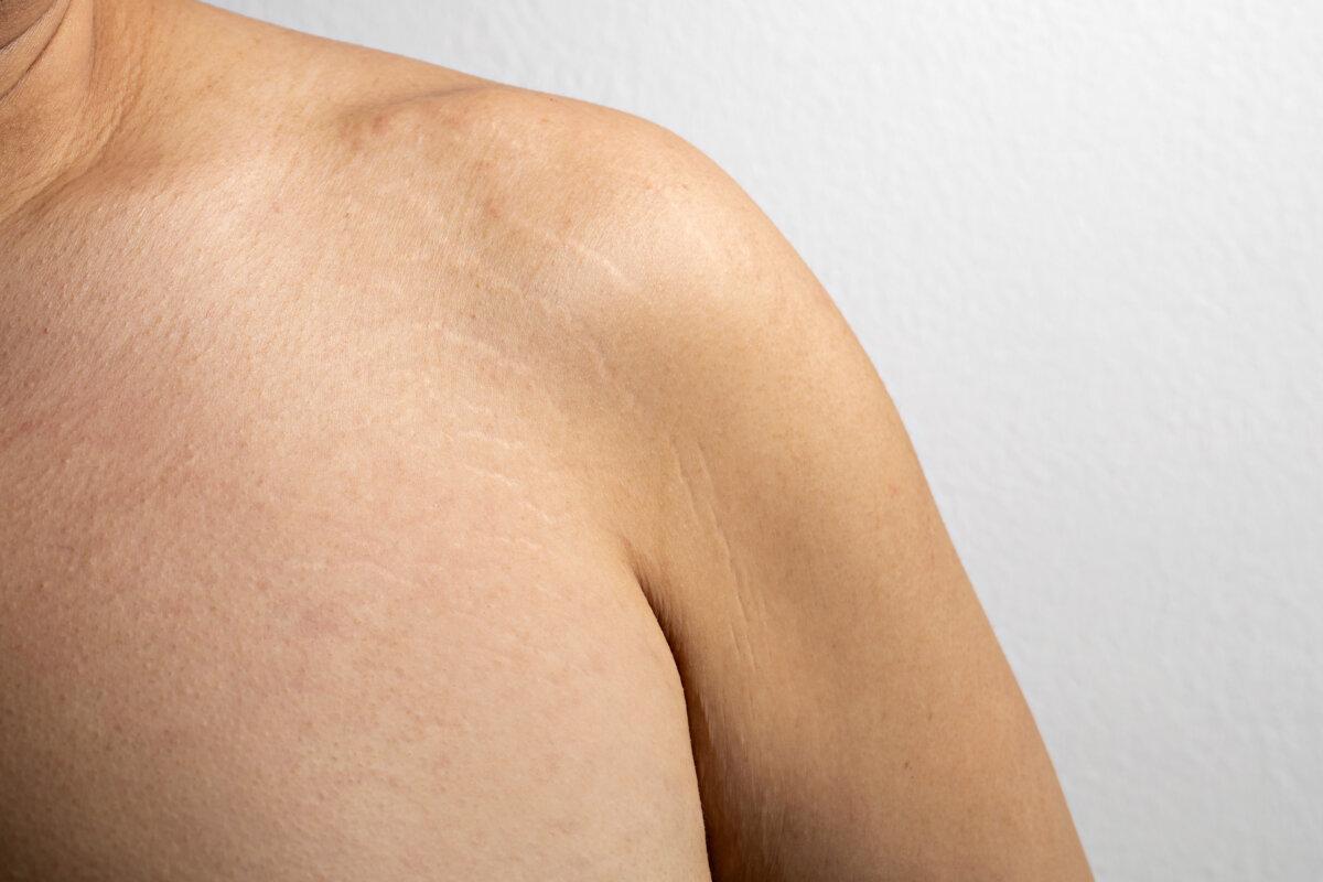 Body striae, stretch marks on an Asian adult arm.