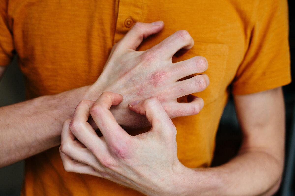Mann kratzt sich, trockene, schuppige Haut an der Hand bei Psoriasis vulgaris, Ekzemen und anderen Hautkrankheiten wie