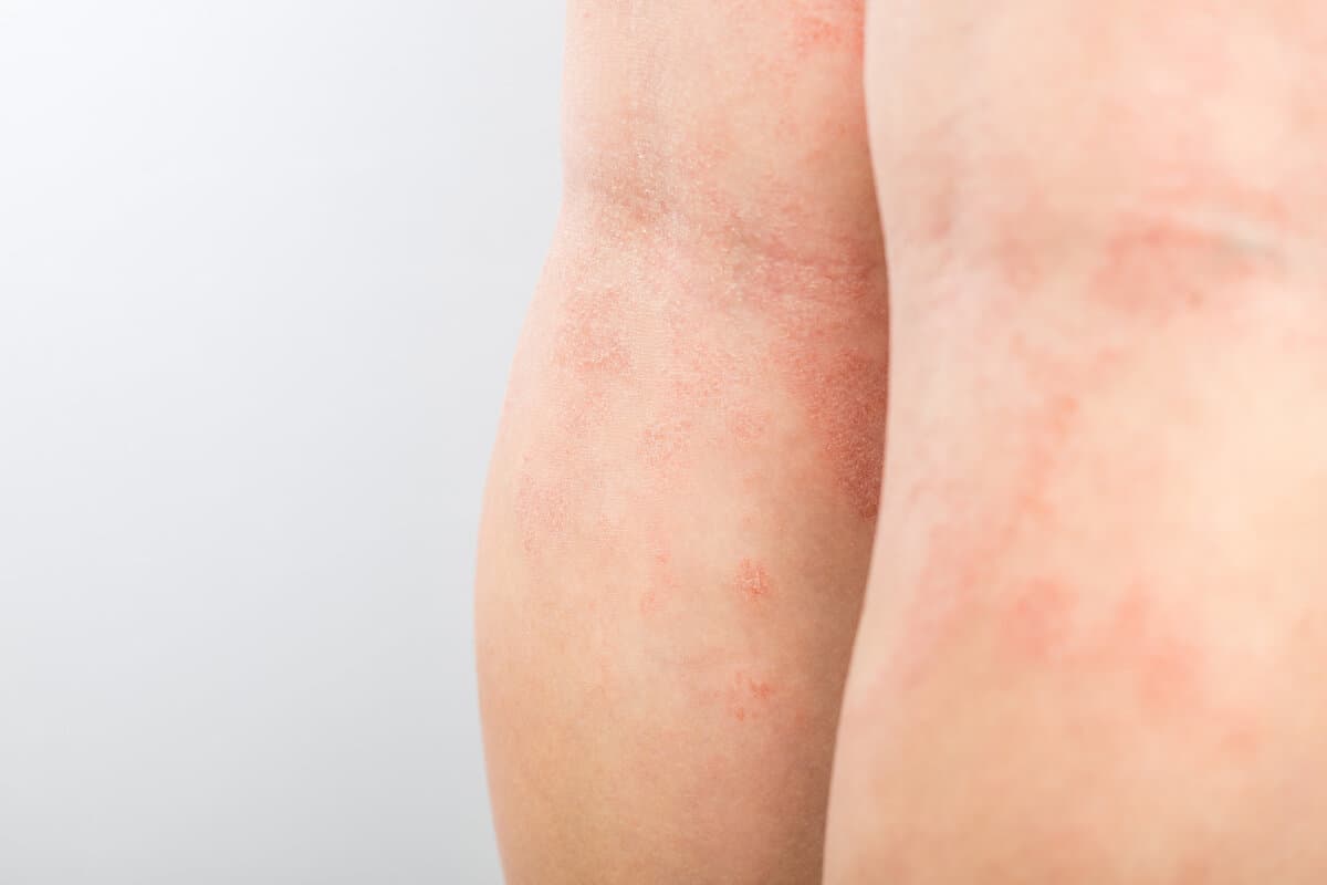 Akute atopische Dermatitis an den Beinen hinter den Knien eines Kindes ist eine dermatologische Erkrankung der Haut.