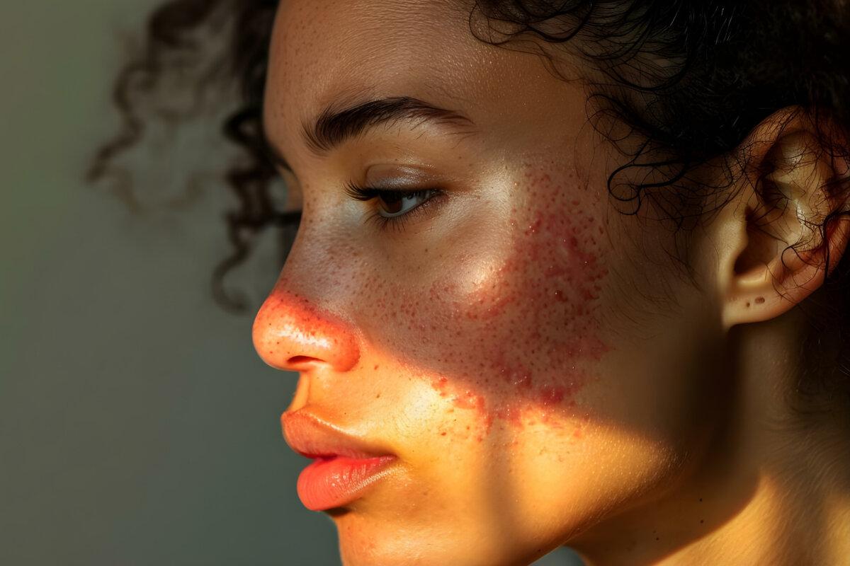 Nahaufnahme einer Frau mit rotem Ausschlag im Gesicht aufgrund von Lupus, die eine Behandlung sucht