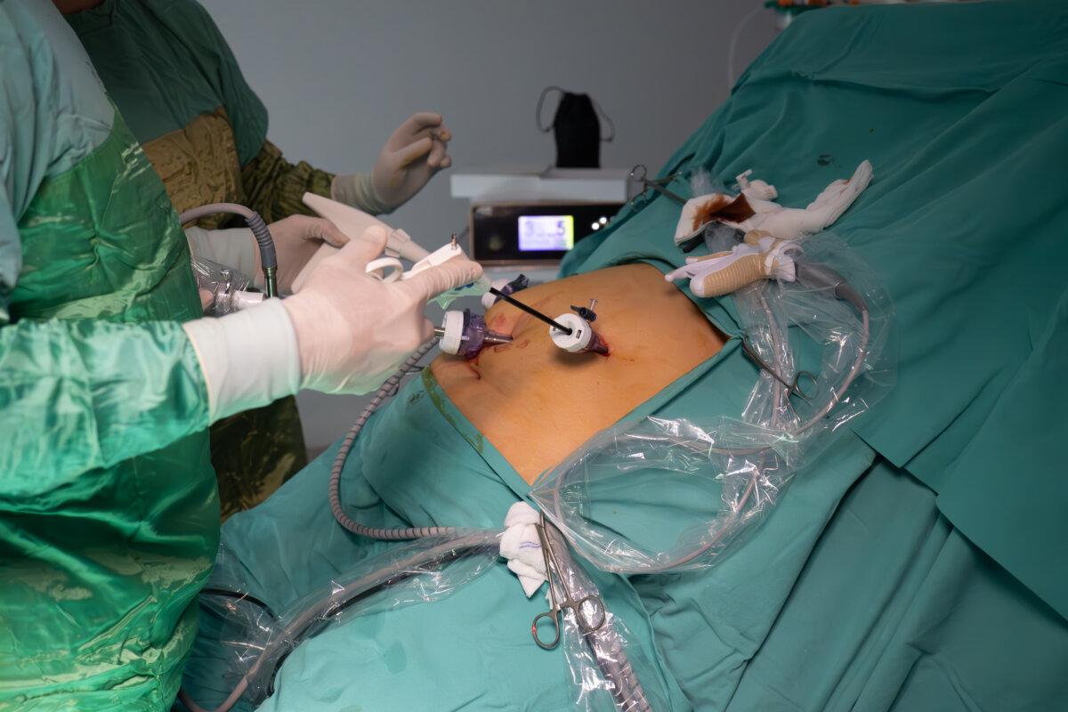 Adipositaschirurgie. Die Gewichtsverlustchirurgie wird mit laparoskopischer Chirurgie durchgeführt.