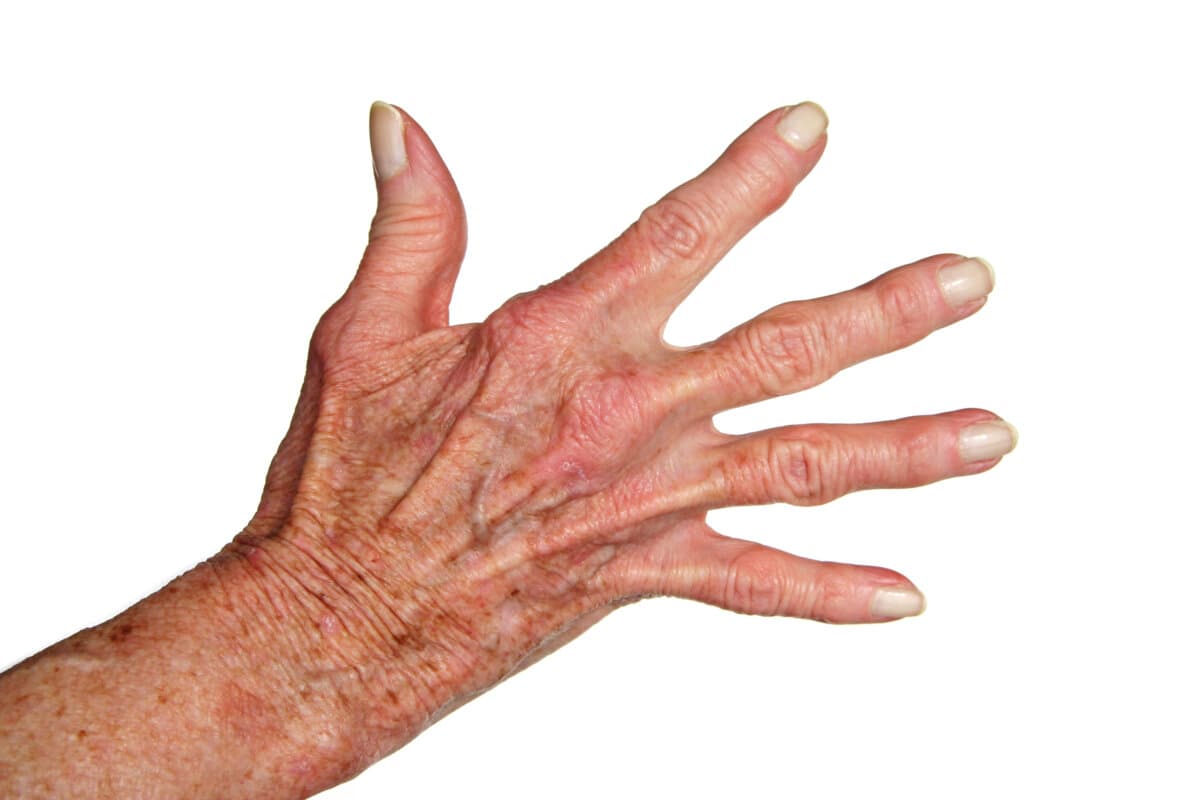 arthritis hand