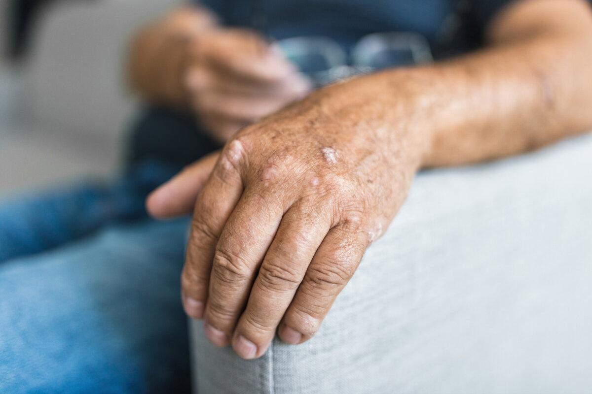 Älterer Mann leidet an Psoriasis, Nahaufnahme an den Händen