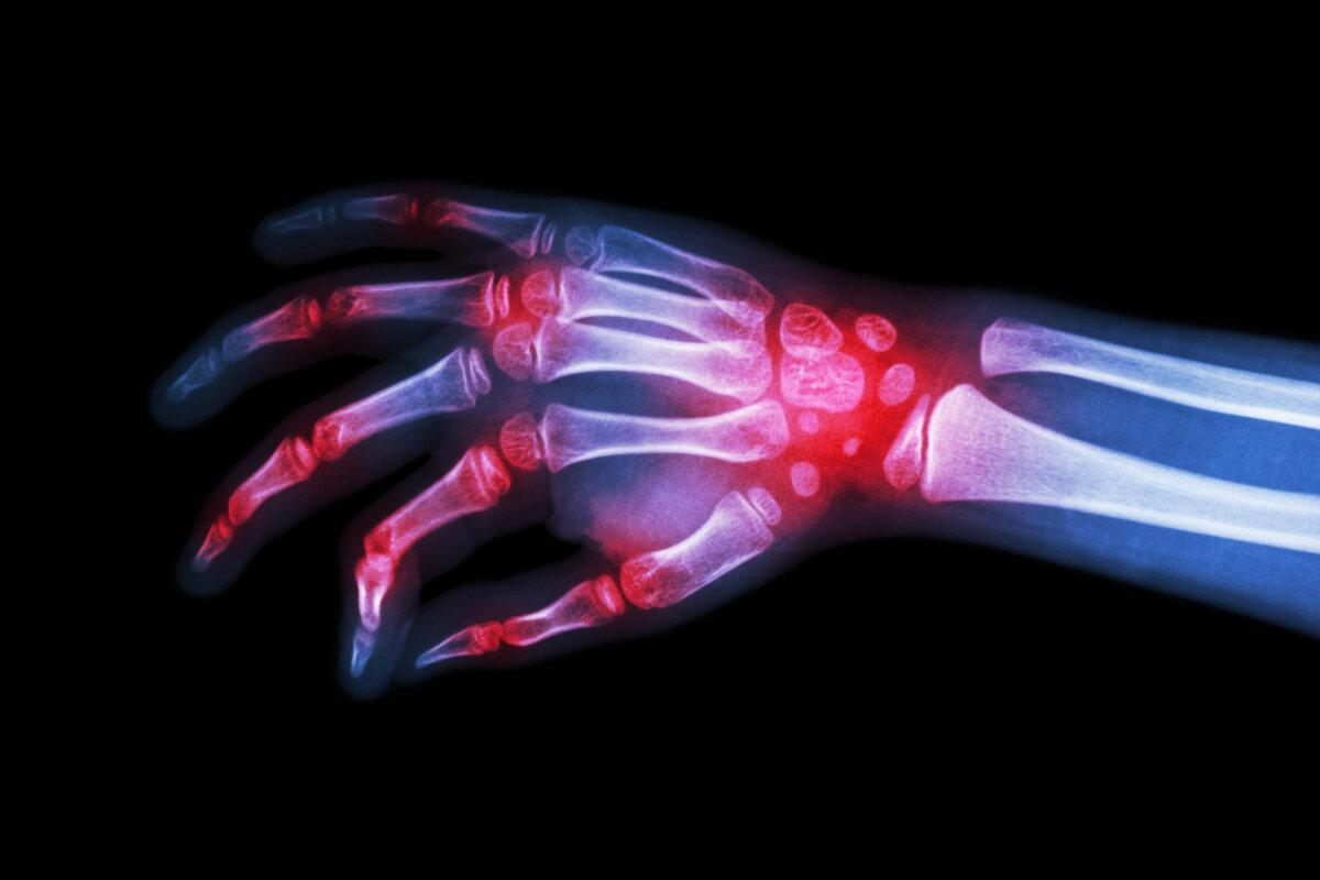 Rheumatoide Arthritis, Gichtarthritis (Röntgenaufnahme der Hand eines Kindes mit Arthritis an mehreren Gelenken)