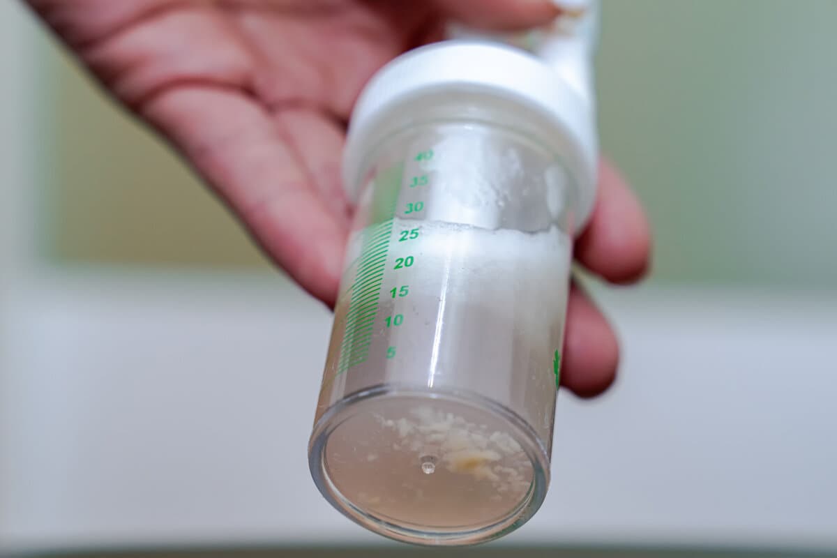 Sample of bronchial lavage after bronchoscopy of a patient