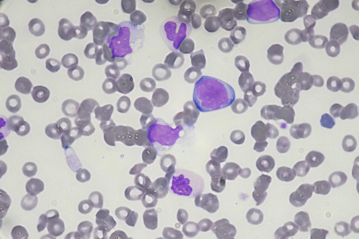 Blast cell (Acute myeloid leukemia in Human)