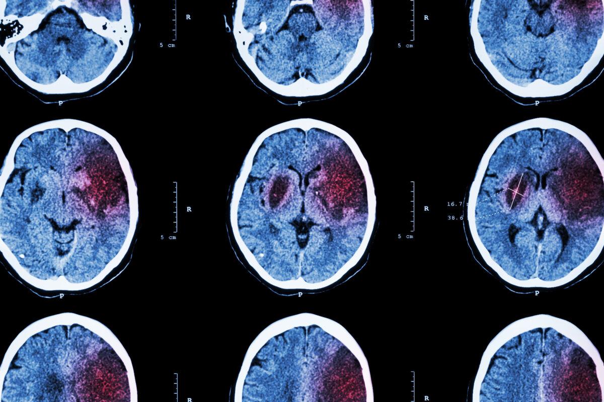 Ischämischer Schlaganfall: (CT des Gehirns zeigt Hirninfarkt links