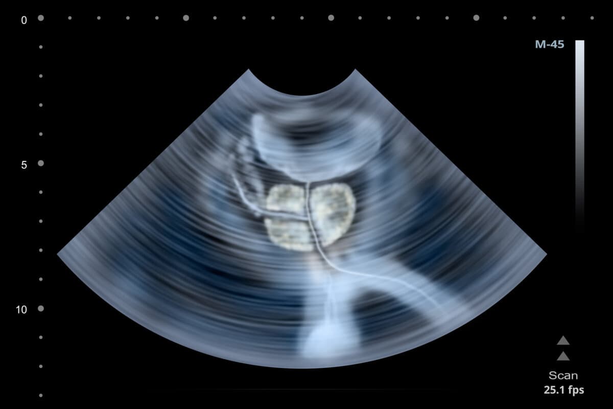 Ultraschalluntersuchung der menschlichen Prostata. Abbildung