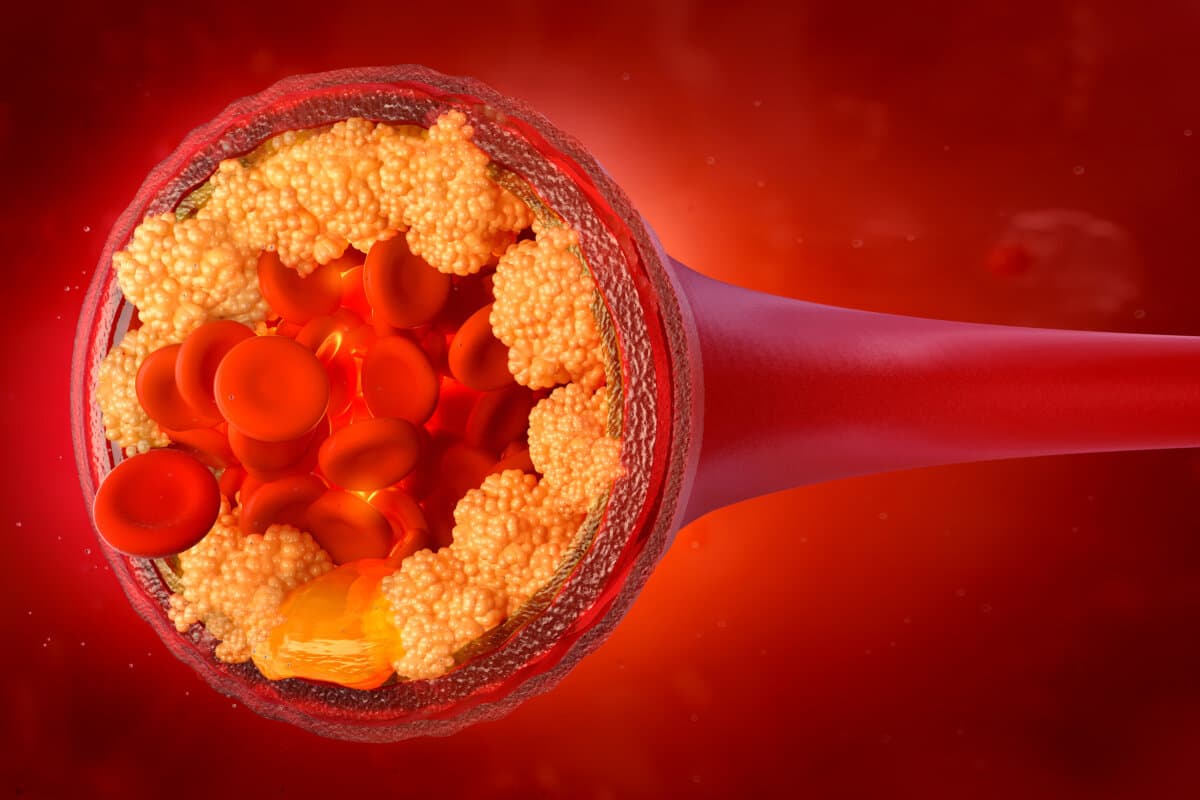 3-D Illustration von LDL-Cholesterin in der Blutbahn.