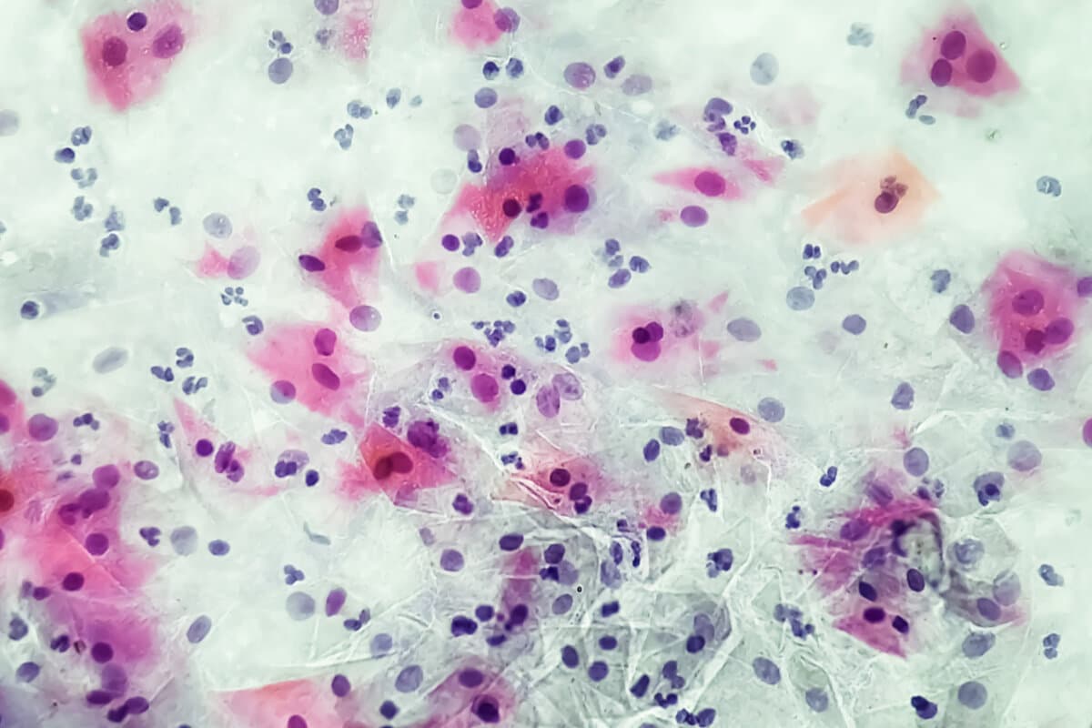 Gardnerella vaginalis Infektion unter dem Mikroskop.