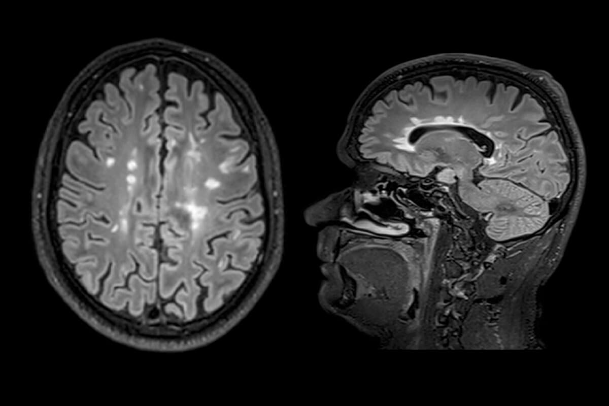 Magnetresonanztomographie mit mehreren entzündlichen Läsionen im Gehirn bei einem jungen Patienten mit Multipler Sklerose und Darstellung entzündlicher Läsionen im Gehirn eines jungen Patienten mit Multipler Sklerose mittels MRT.