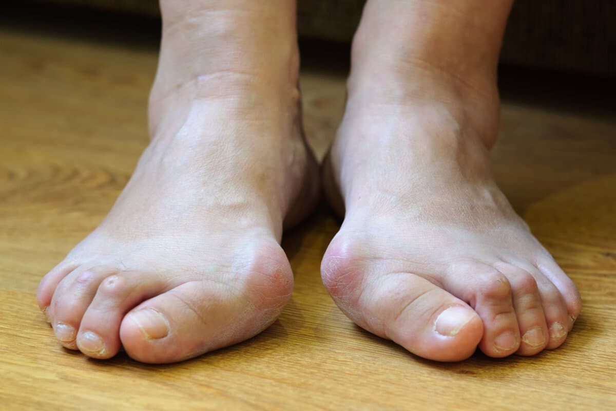 Problemfüße mit Ballenzehen (Hallux valgus)