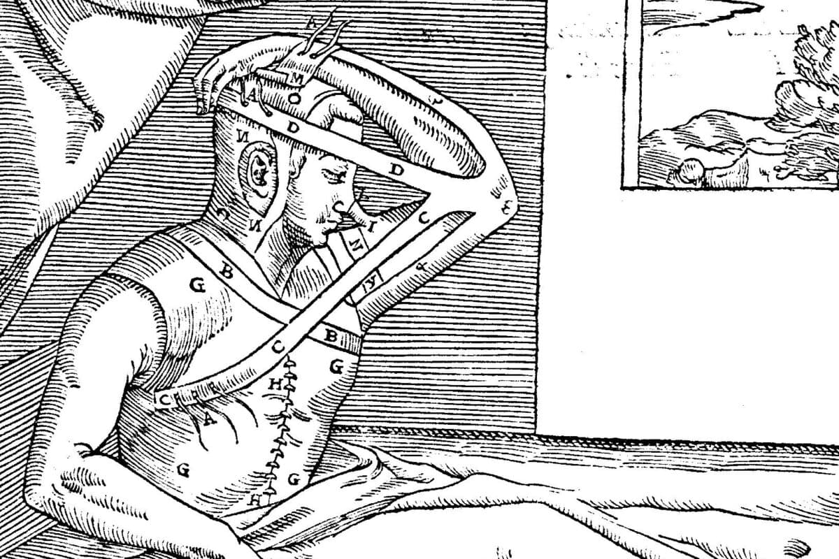 Detail eines Kupferstichs aus "De Curtorum Chirurgia per Insitionem" („Über die Chirurgie der Verstümmelung durch Transplantation“) aus 1597 von Gaspare Tagliacozzi.