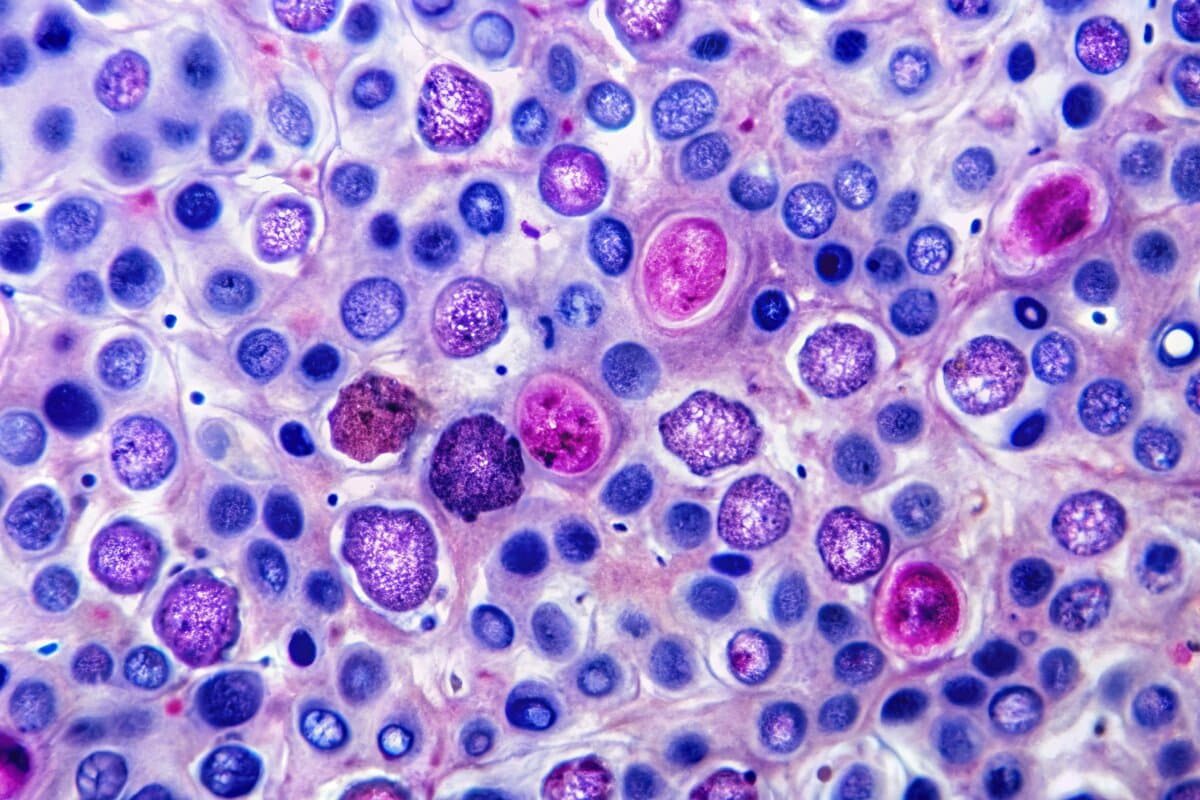 Non-Hodgkin Lymphom