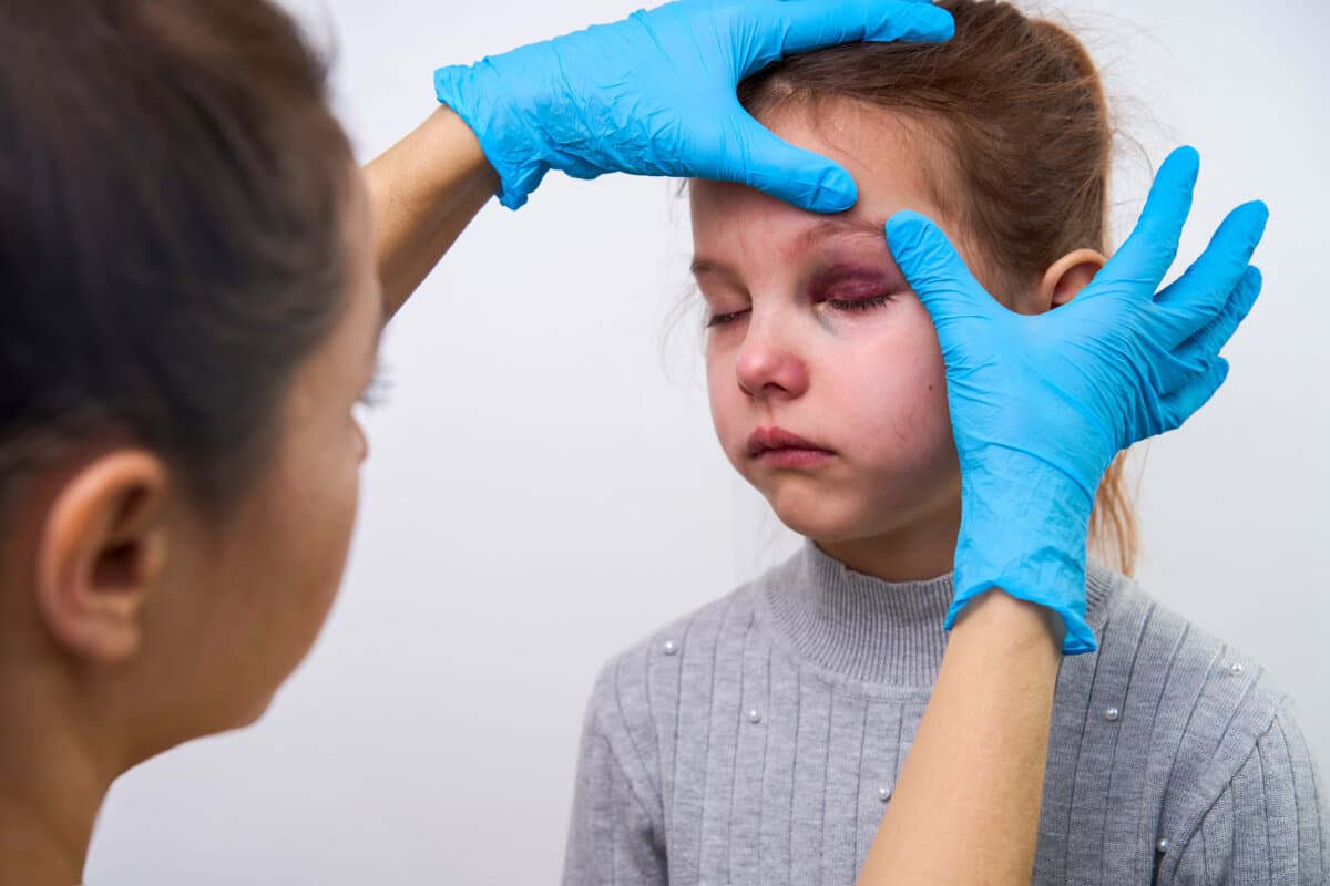 Arzt untersucht Mädchenauge mit Prellung im Krankenhaus, Nahaufnahme