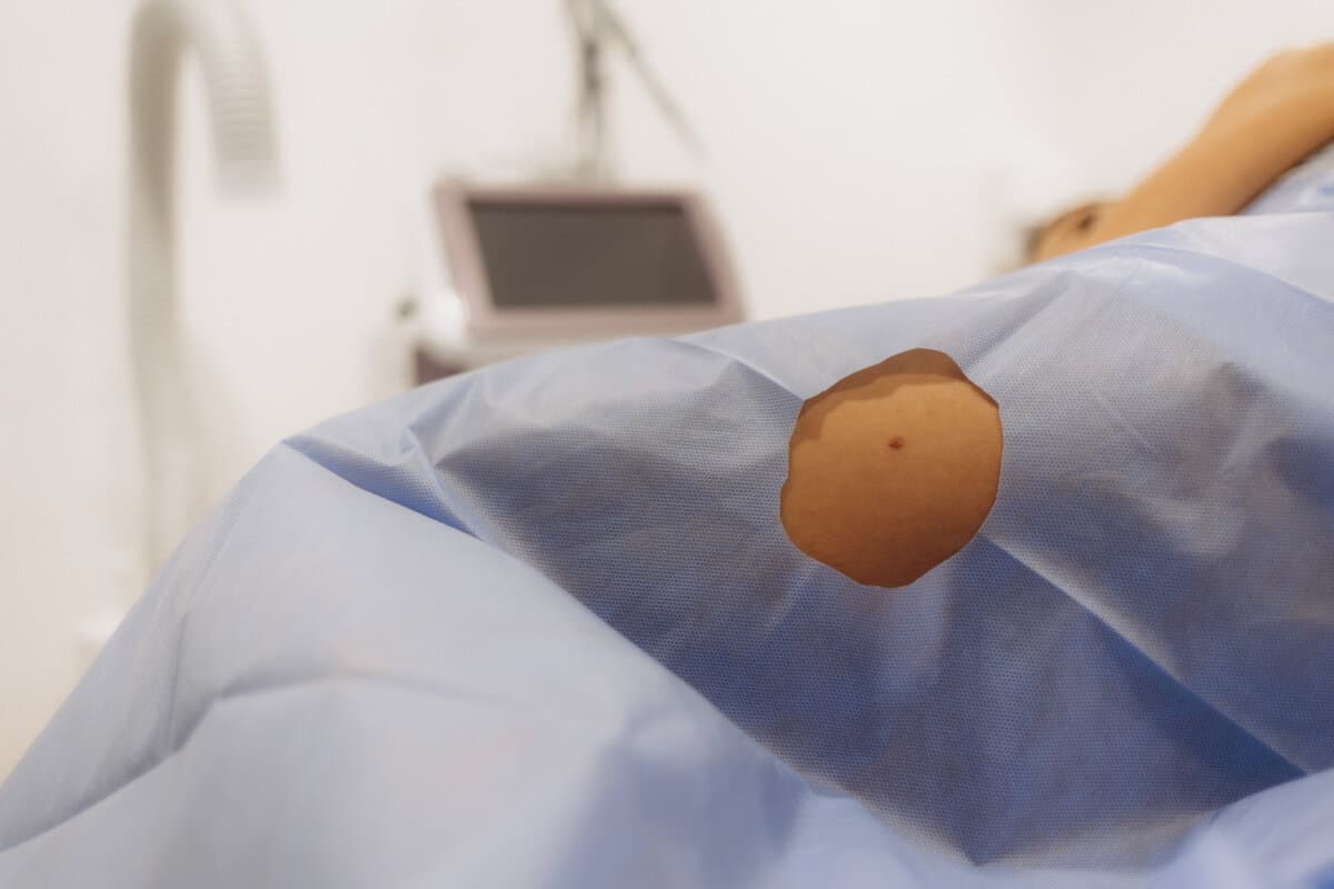 der Chirurg entfernt chirurgisch ein Muttermal - chirurgische Entfernung eines Muttermals -