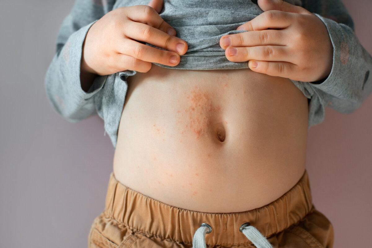 Windpocken beim Baby. Das Varicella-Zoster-Virus oder Krätze-Ausschlag beim Kind.