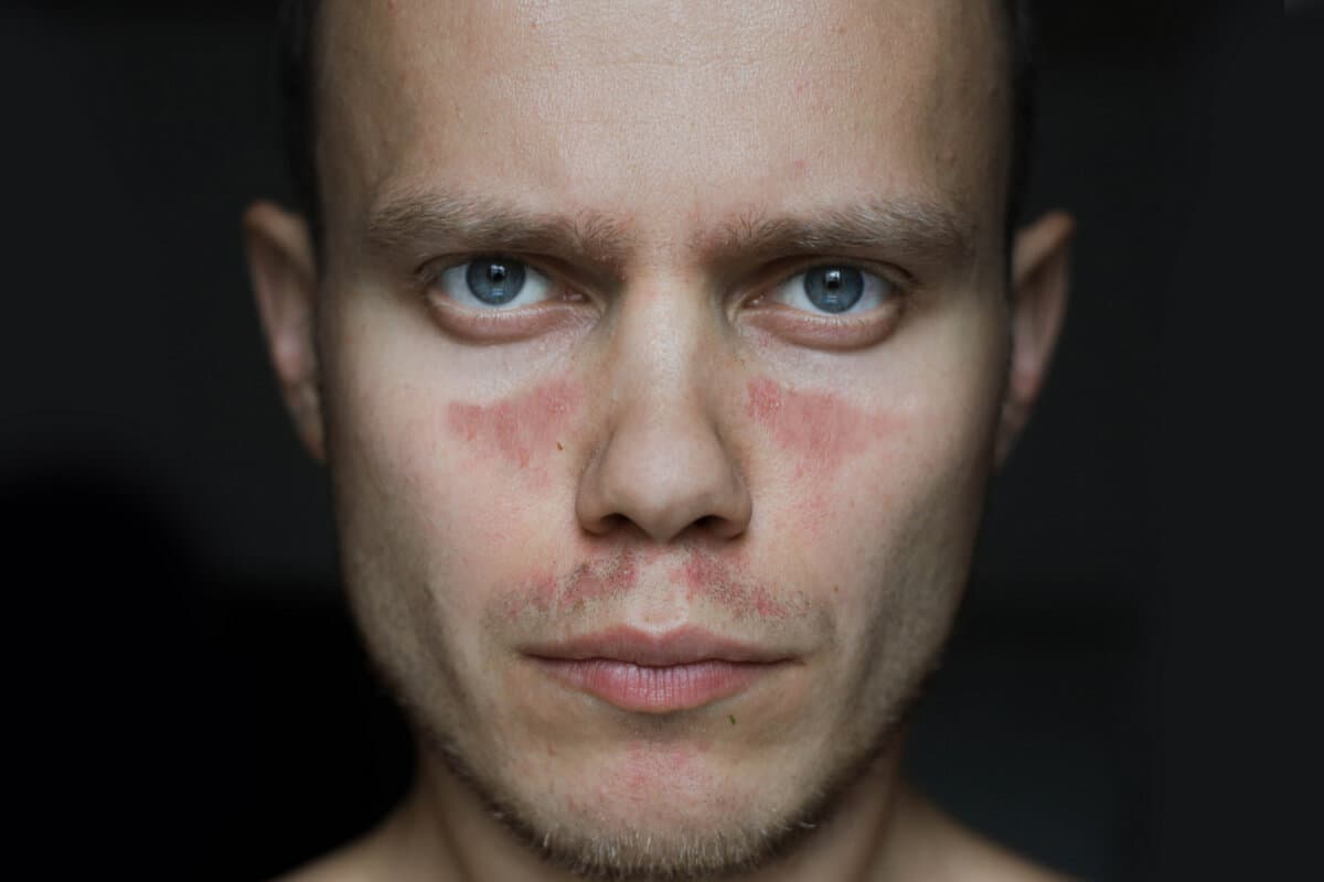 Mann mit Ausschlag im Gesicht.