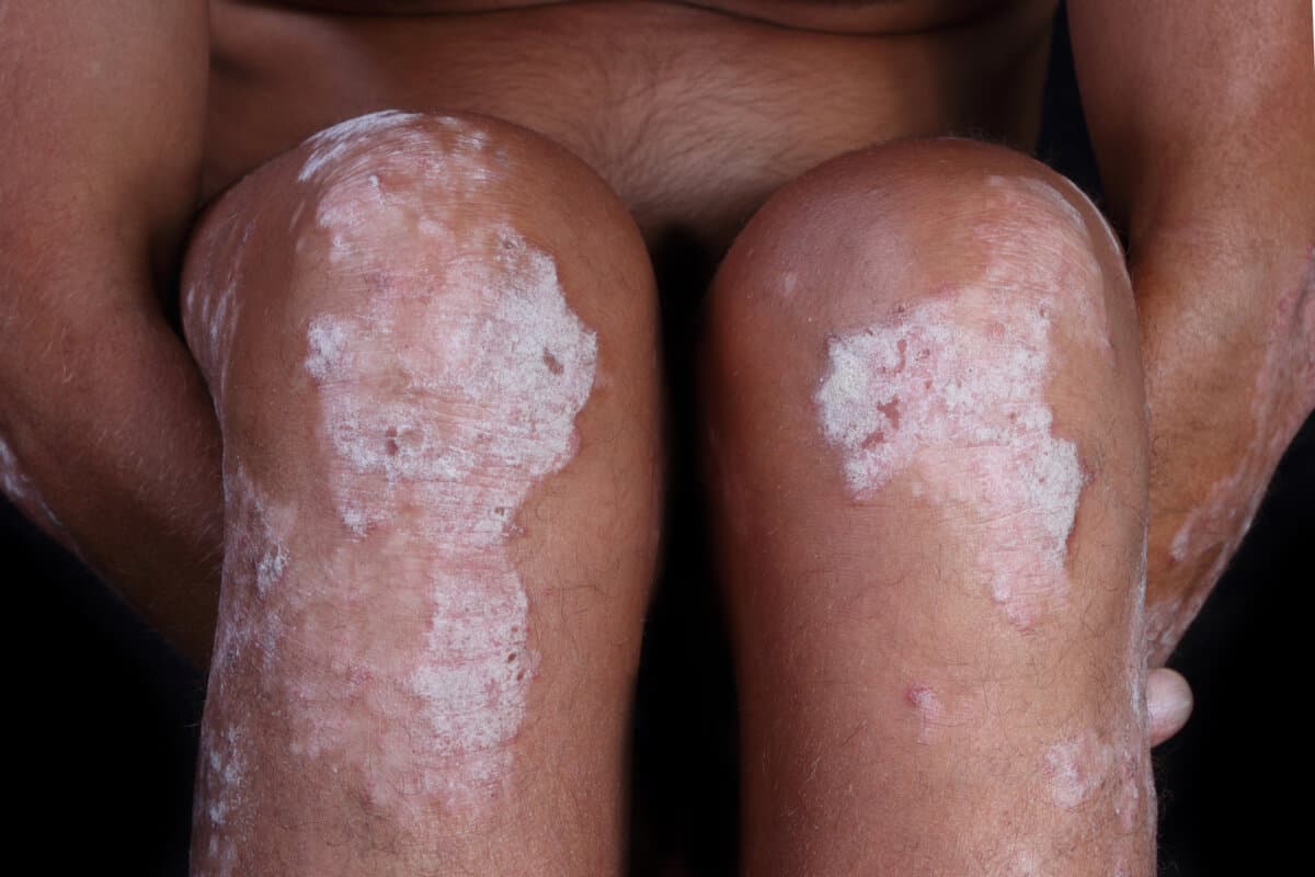 Mann mit Psoriasis an den Beinen.