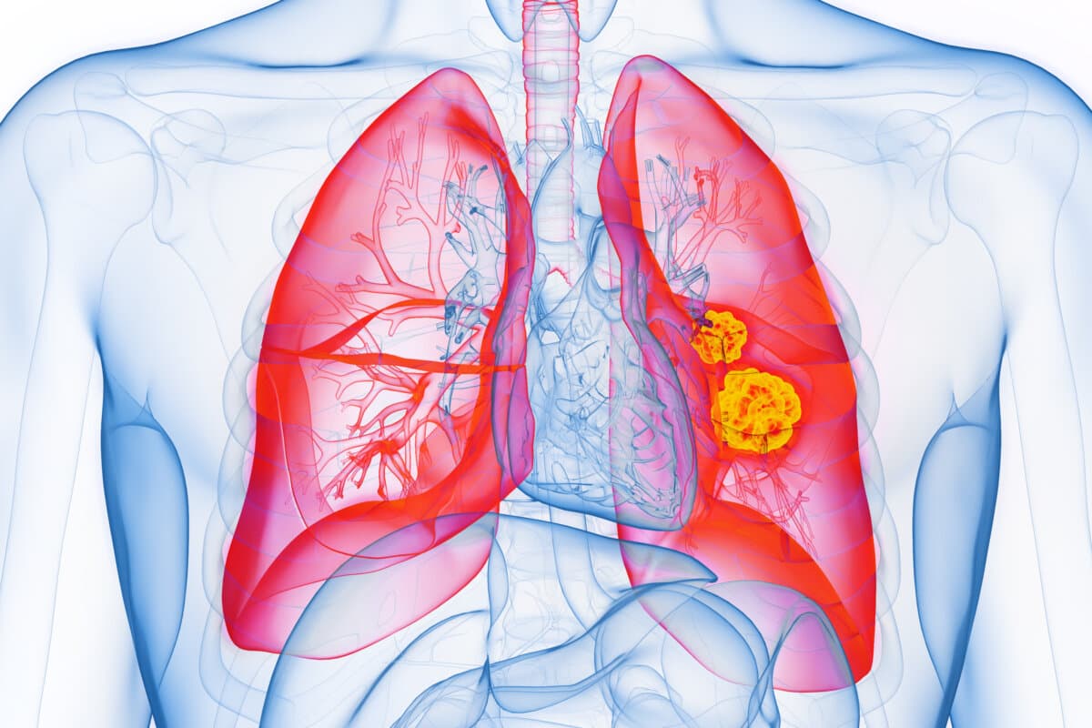 3D-gerenderte medizinische Illustration der männlichen Anatomie - Lungenkrebs. Einfacher weißer Hintergrund.
