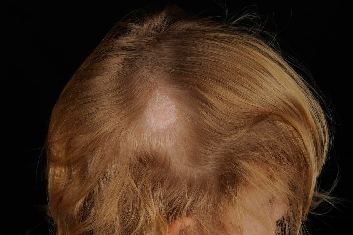Tinea capitis – Mikrosporie