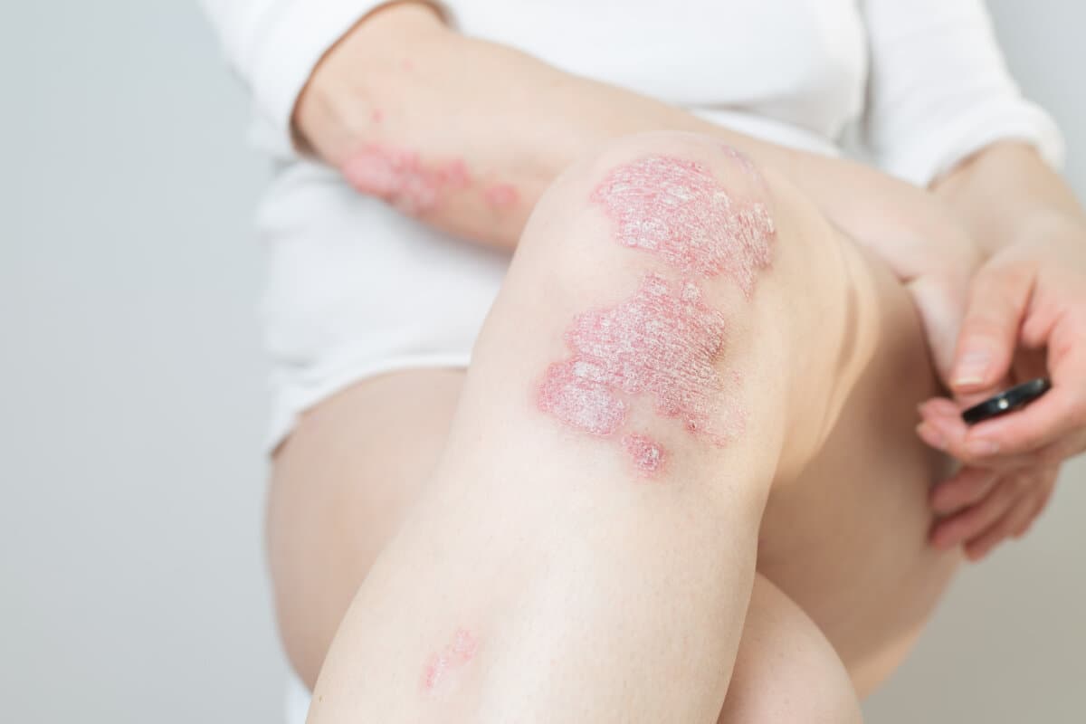 Akute Psoriasis an Knien, Körper und Ellenbogen ist eine unheilbare Autoimmunerkrankung der Haut.