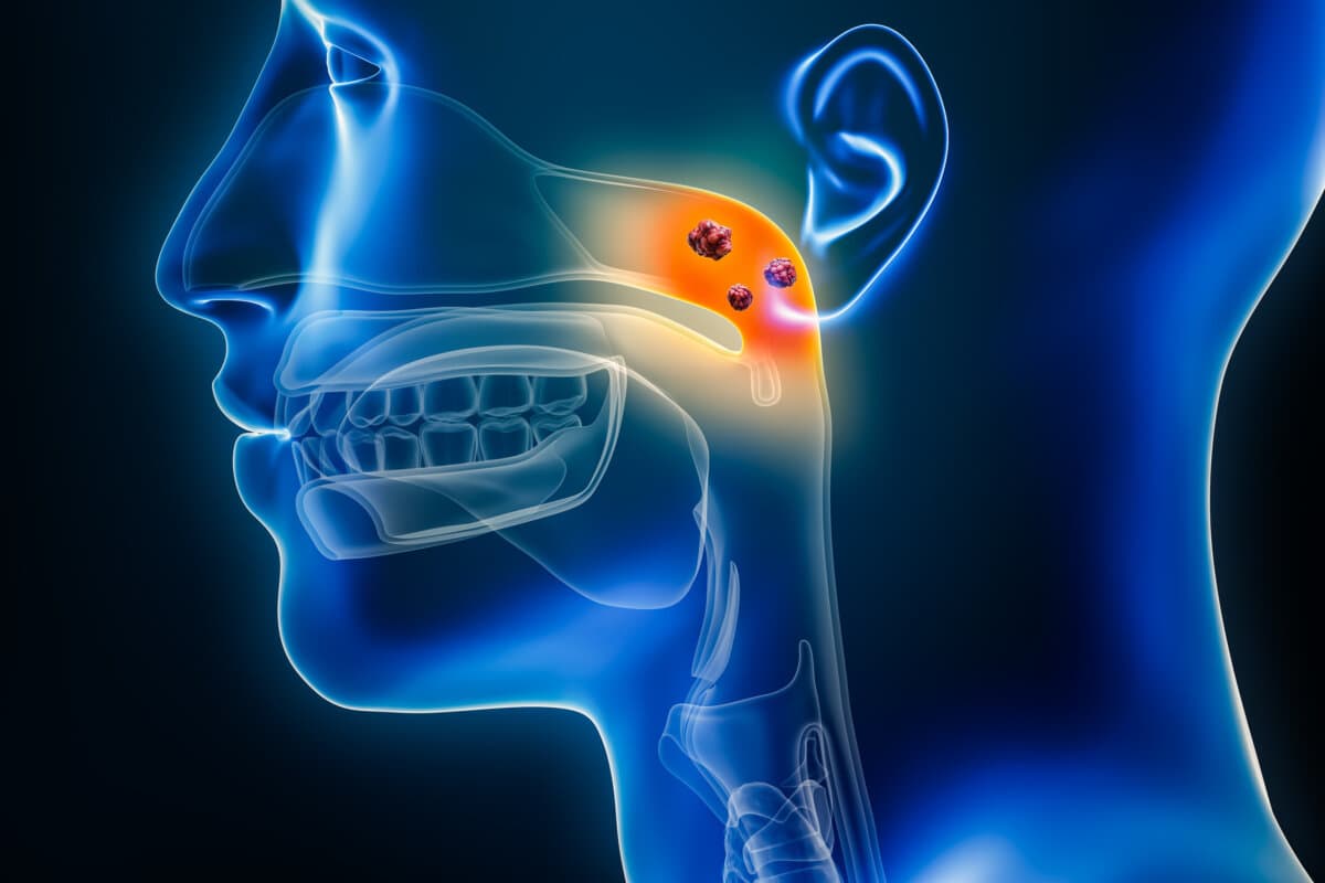 Nasopharynxkrebs mit Organen und Tumoren oder Krebszellen, 3D-Darstellung.