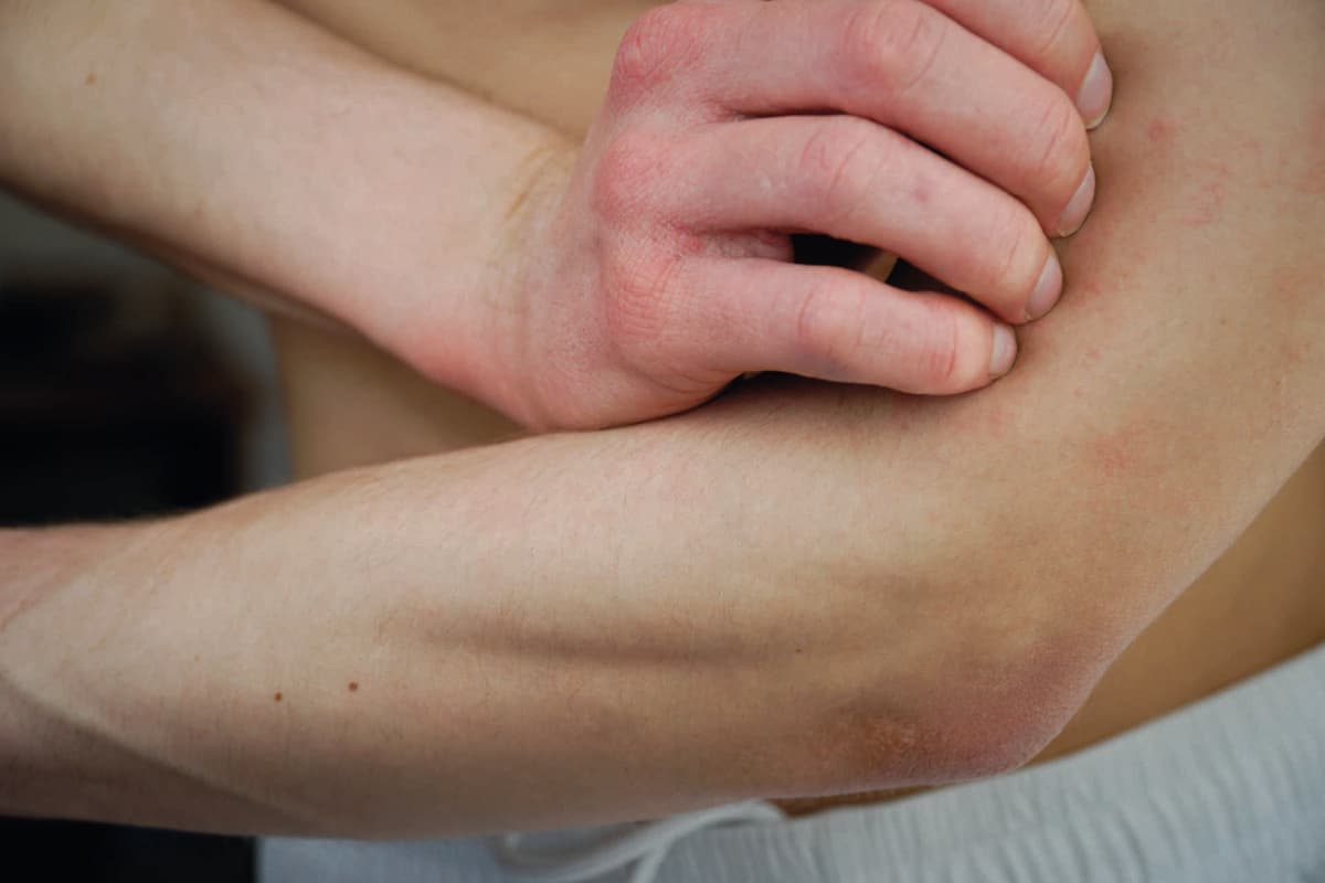 Juckreiz bei atopischer Dermatitis