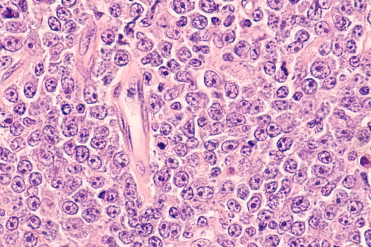 Diffuses großzelliges B-Zell-Lymphom