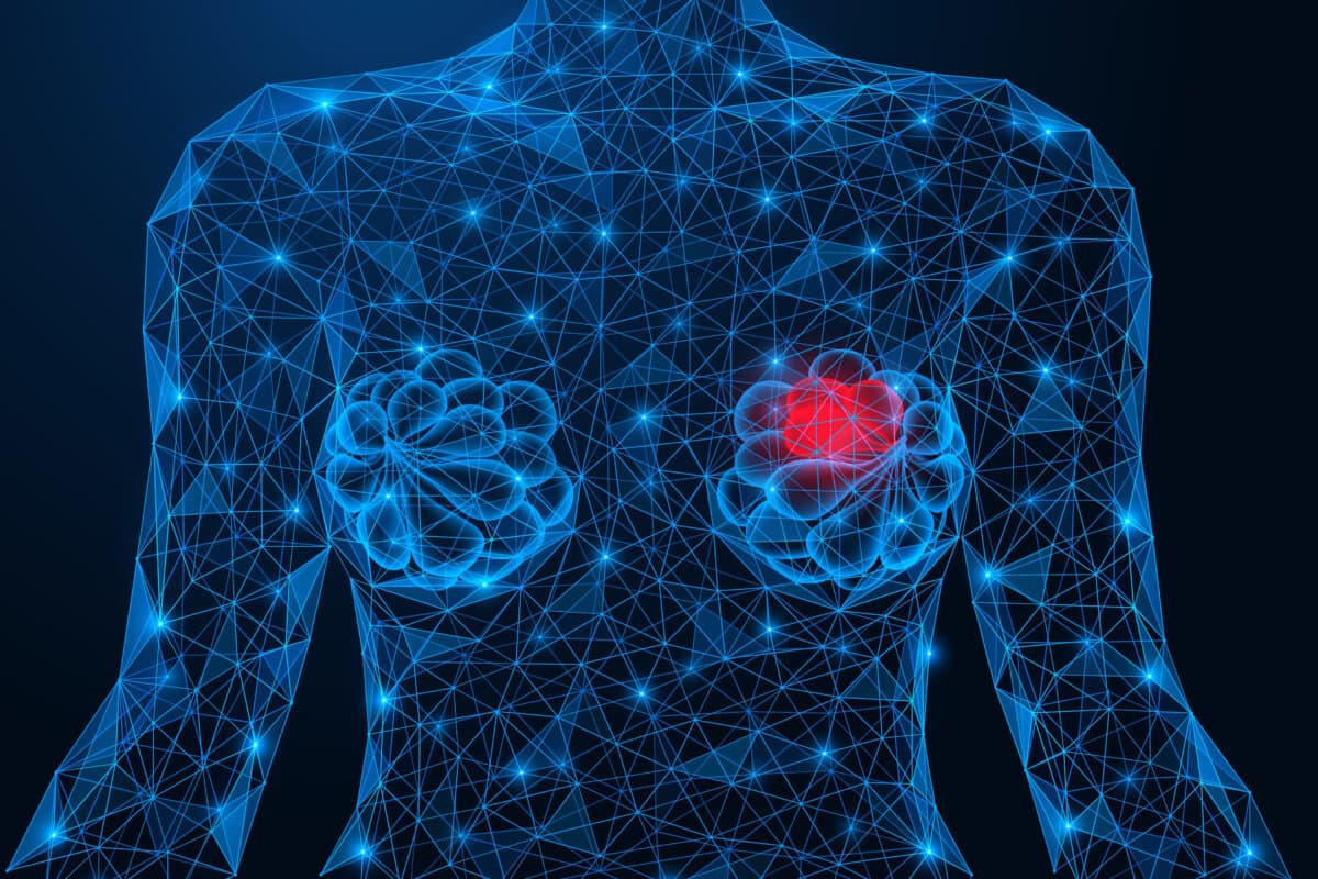 Illustration Brustkrebs