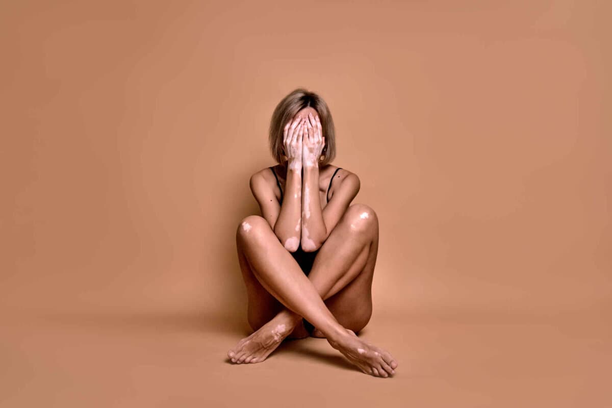 Girl with vitiligo disease covers her face with hands, closeup portrait on beige background