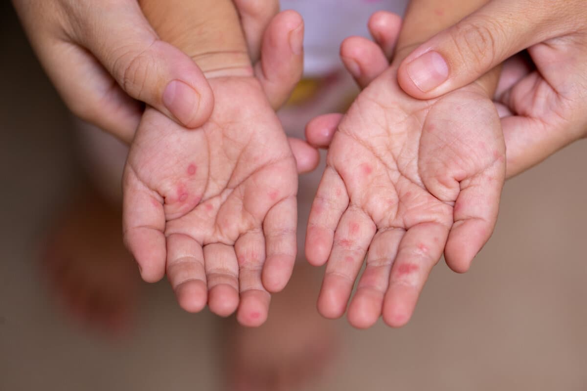 Die Hände eines Kindes, welche Symptome der Hand-Mund-Fuß-KRankheit zeigen.