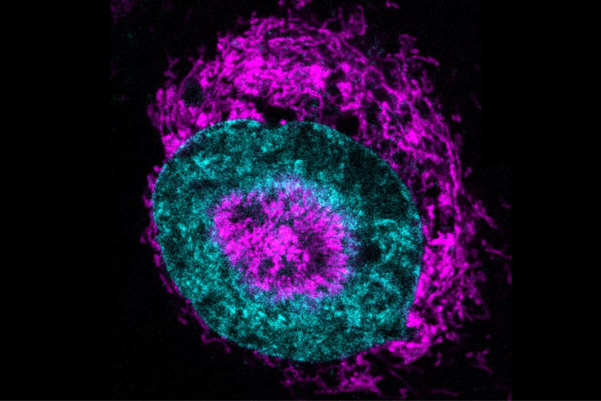 Das Innere einer gequetschten Krebszelle, in der sich die Mitochondrien (pink) außen am Zellkern (cyan) und in „Vertiefungen” des Zellkerns ansammeln.