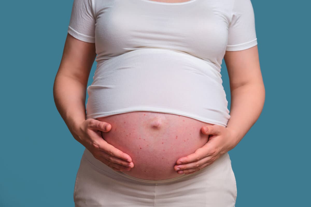 Akne auf dem Bauch einer schwangeren Frau, Studiofoto auf blauem Hintergrund