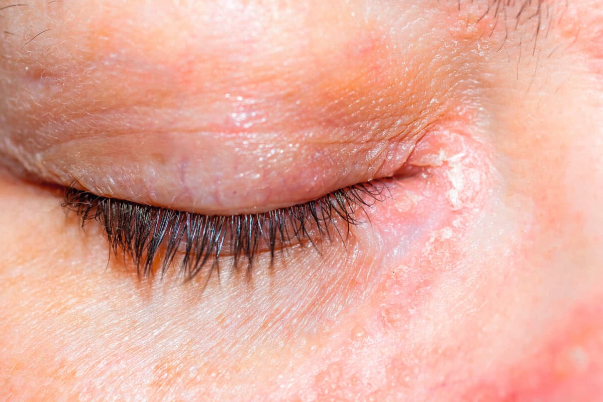 Psoriasis am auge