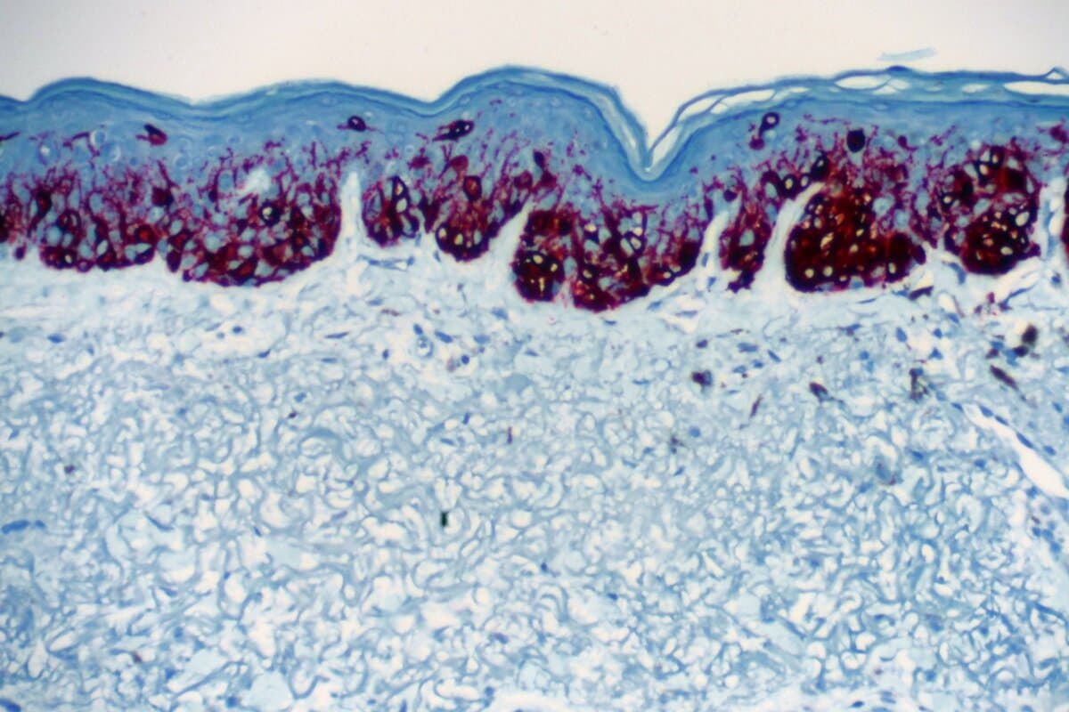 Wann kann man bei Melanom die ICI-Therapie beenden?