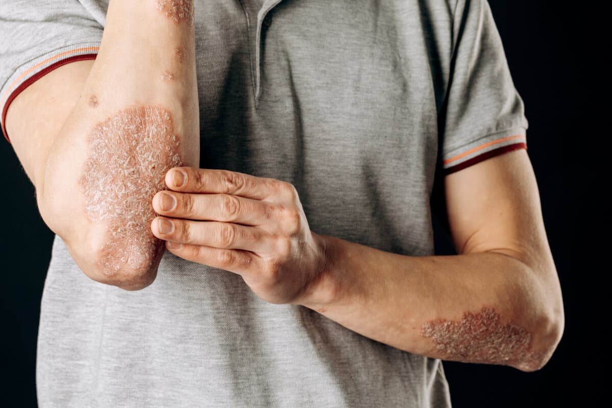 Akute Psoriasis an den Ellbogen ist eine unheilbare, autoimmunbedingte Hauterkrankung.
