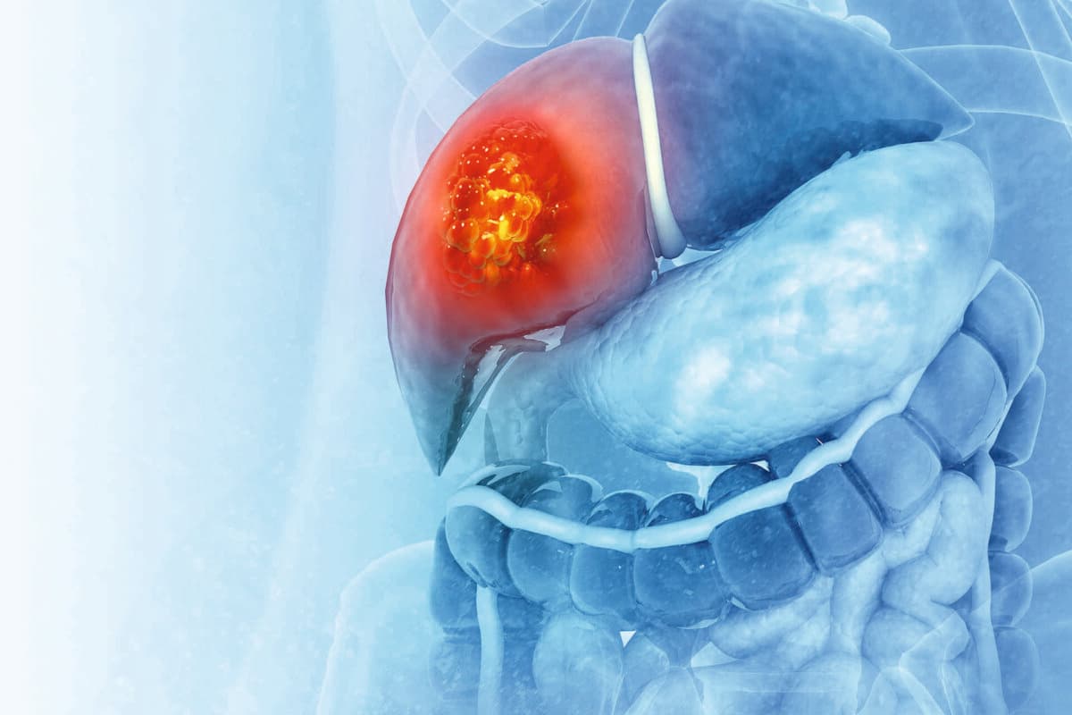 Liver cancer or liver tumor, Hepatocellular carcinoma (HCC), causes, symptoms, treatments, 3d illustration