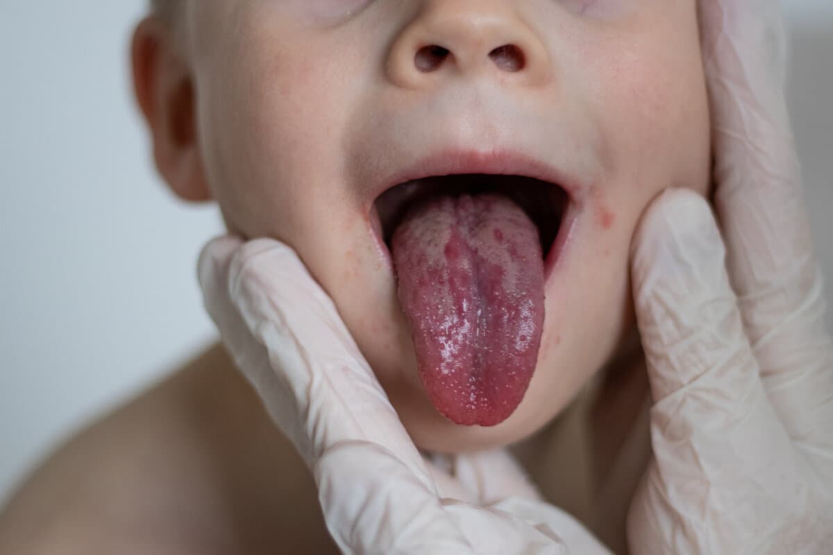 Close up of a pediatrician doctor checking a small boys tongue and mouth. Red strawberry tongue of scarlet fever disease