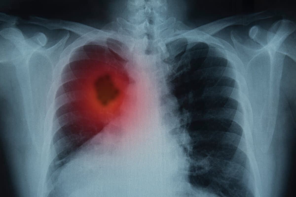 Lung Cancer. X-ray image of patient lungs to lung tumor.