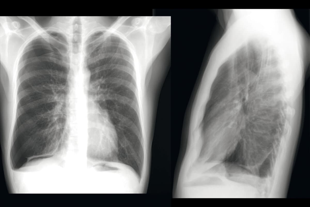 32-jähriger Mann mit respiratorischem Infekt und Atemnot seit 6 Wochen.